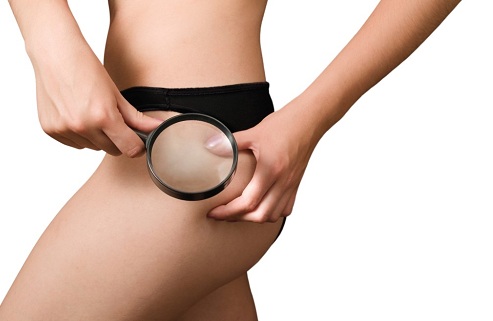 cellulite treatment at clarity medspa