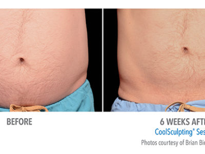 coolsculpting men