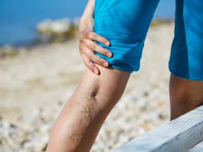 Woman touching painful varicose veins on a leg