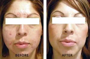 treating acne on face