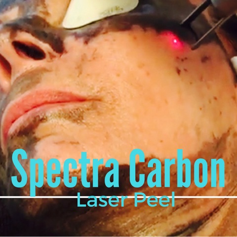 spectra carbon clarityMedSpa