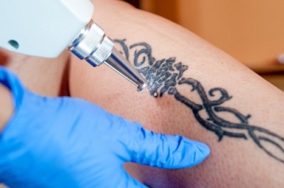 safe laser tatoo removal
