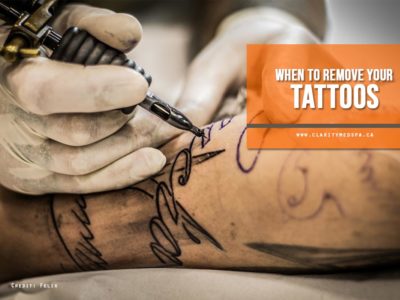 When to remove your tattoos