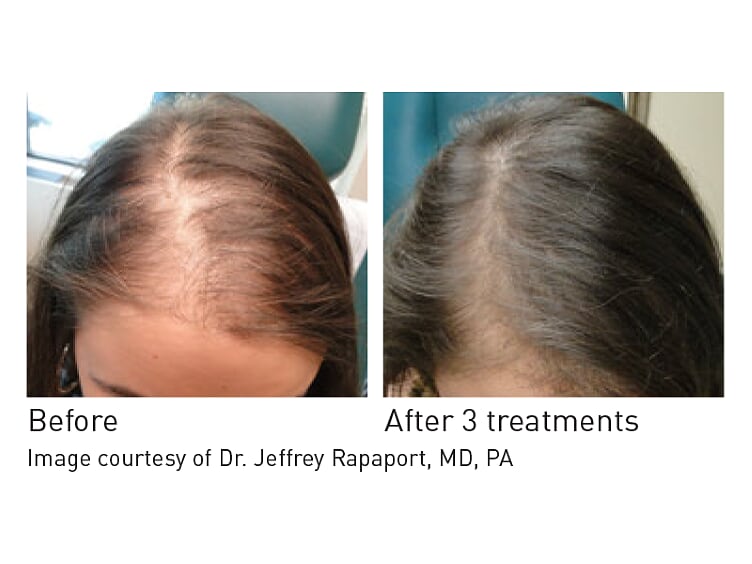 Hair Loss Restoration PRP Toronto - Clarity MedSpa