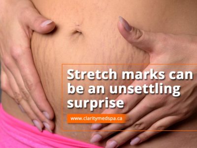 strech marks