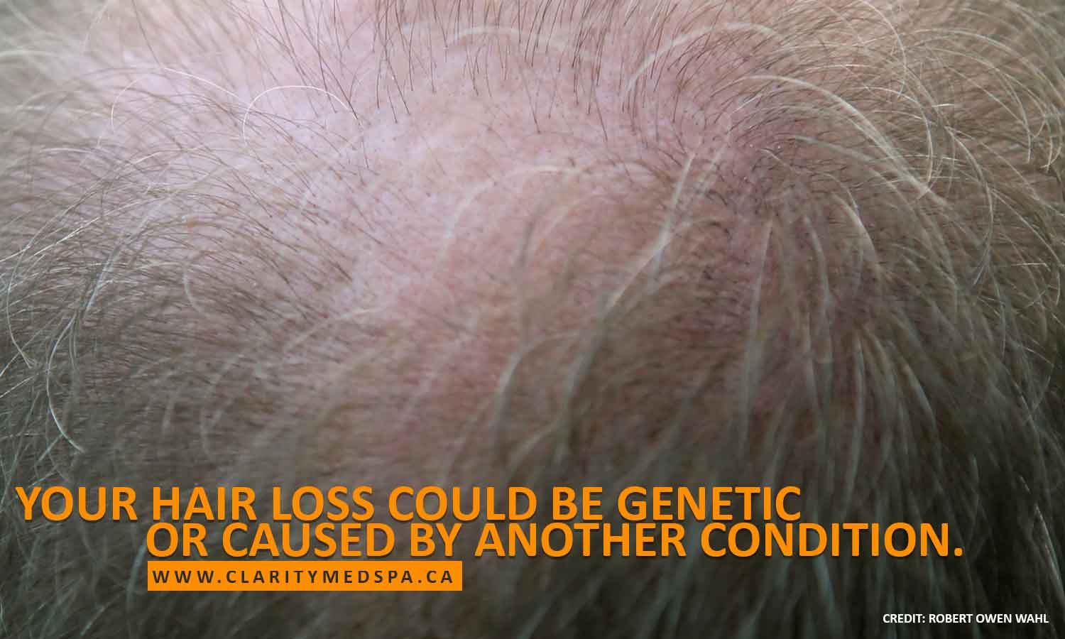 genetic hair loss