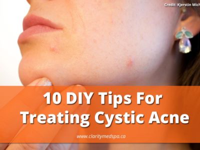treating cystic acne