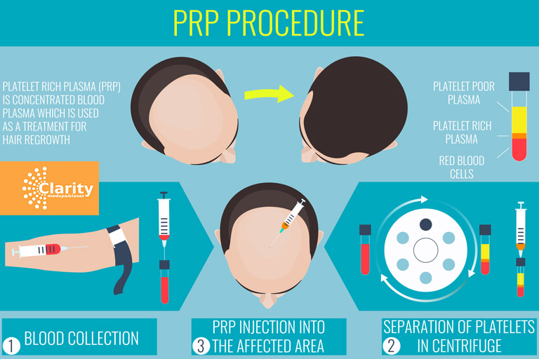 Does-PRP-Really-Regrow-Hair