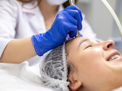 Microneedling with Exosomes: Is It Right for Me?