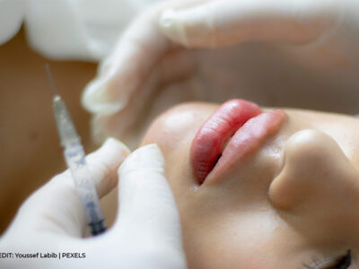 The Art of Lip Fillers: Avoiding the Sausage Lips and Getting the Most Flattering Results